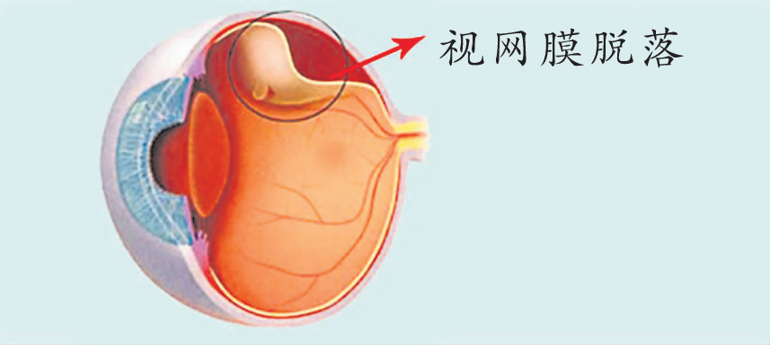 我右眼看到黑影了