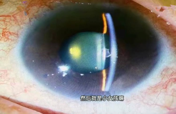 關燈看手機惹禍 女大生“眼珠發白”就醫