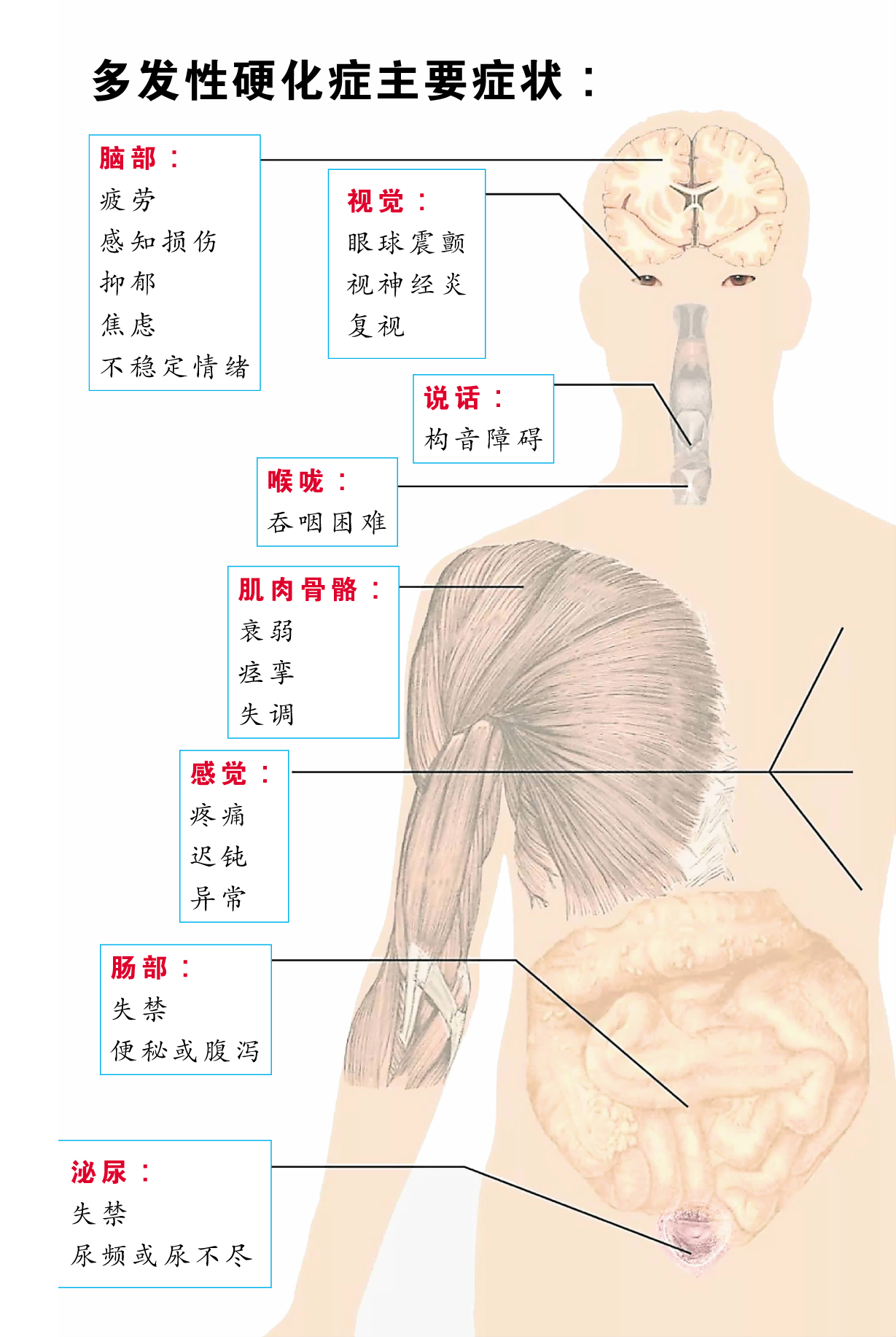 多发性硬化症,Multiple Sclerosis,MS,千面疾病,罕见疾病,疾病修正治疗,Disease Modifying Treatments,DMT,吉隆坡中央医院,神经内科,珊迪维斯瓦纳丹医生,Dr Shanti Viswanathan,默克,Merck,核磁共振成像扫描,MRI,诱发电位测试,Evoked Potential Tests,EP,脑脊髓液,CSF,中寡克隆区带,OCB,神经轴突,axon,髓鞘手酸,脱髓鞘,Demyelinating,肥胖,抽烟,病毒感染,埃博斯坦巴尔病毒 ,Epstein-Barr Virus,复发缓解型阶段,PR phase,免疫引起的发炎反应,渐进期,progressive phase,神经退化,非创伤性残疾,