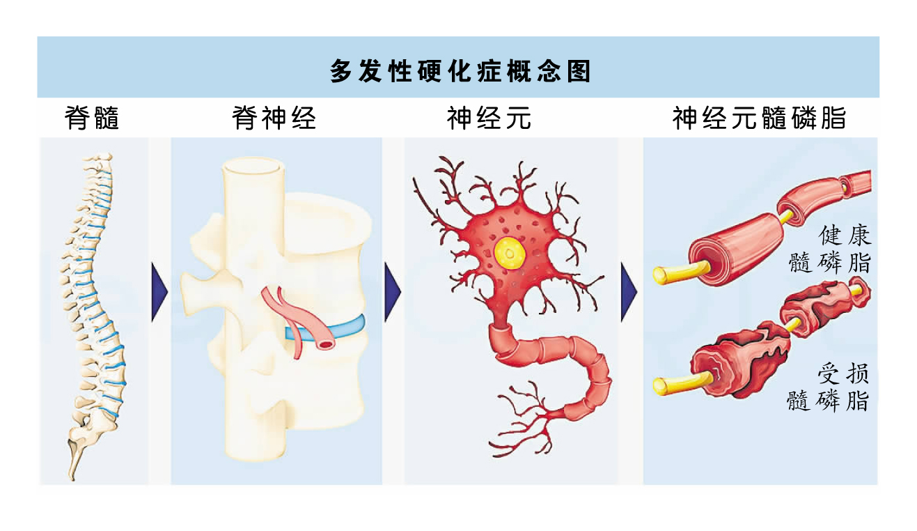 多发性硬化症,Multiple Sclerosis,MS,千面疾病,罕见疾病,疾病修正治疗,Disease Modifying Treatments,DMT,吉隆坡中央医院,神经内科,珊迪维斯瓦纳丹医生,Dr Shanti Viswanathan,默克,Merck,核磁共振成像扫描,MRI,诱发电位测试,Evoked Potential Tests,EP,脑脊髓液,CSF,中寡克隆区带,OCB,神经轴突,axon,髓鞘手酸,脱髓鞘,Demyelinating,肥胖,抽烟,病毒感染,埃博斯坦巴尔病毒 ,Epstein-Barr Virus,复发缓解型阶段,PR phase,免疫引起的发炎反应,渐进期,progressive phase,神经退化,非创伤性残疾,