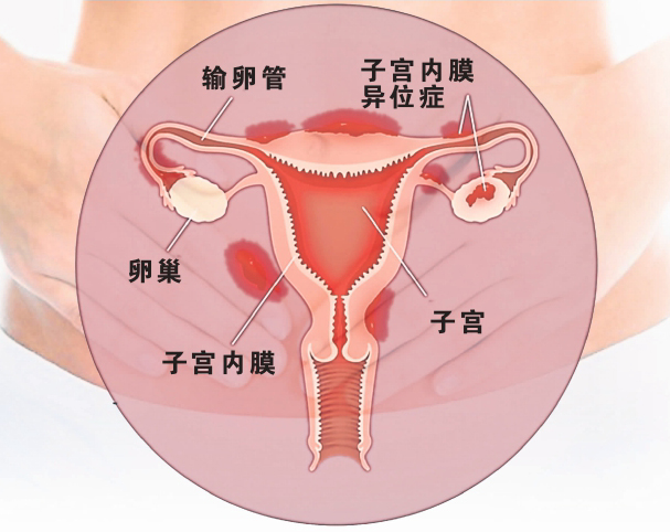 子宮內膜異位