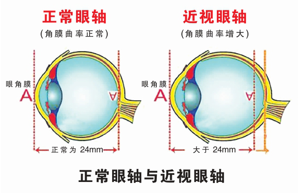 儿童近视管理新概念