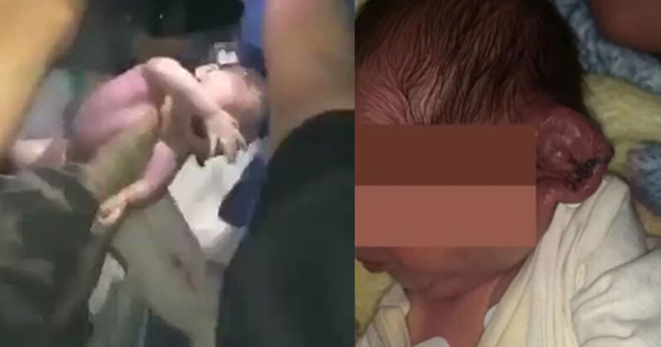 剖腹产停电·用手机照明 医生割断新生儿耳朵