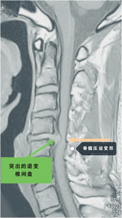 突出的退变 椎间盘