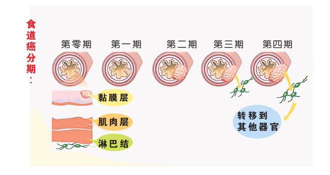 食道癌 图表