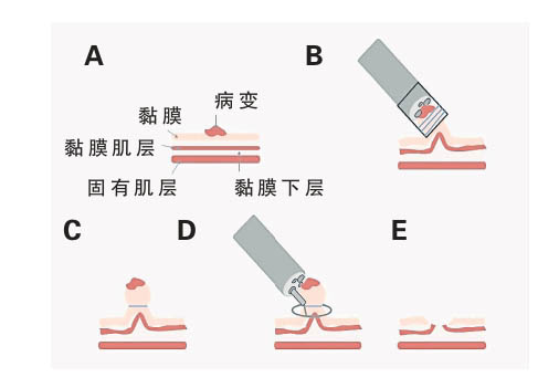 内窥镜治疗