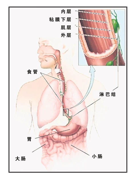 食道癌