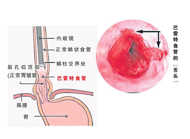 雷特食管