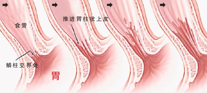 逆流性食管炎