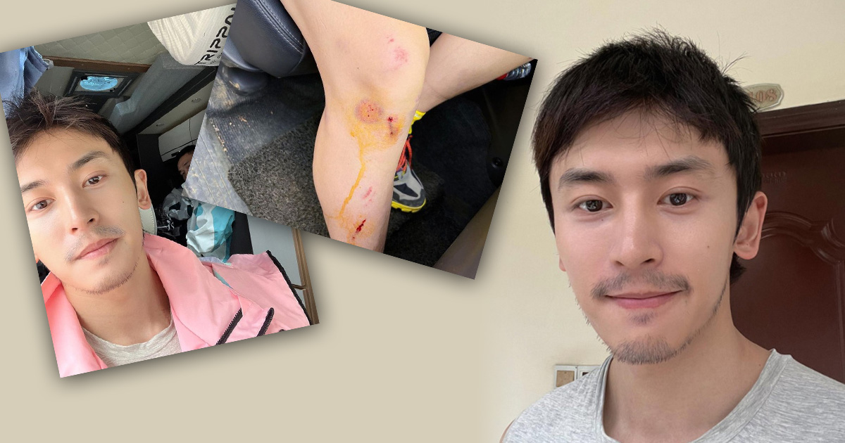 封殺後出車禍傷口冒血  張哲瀚憔悴近況曝光