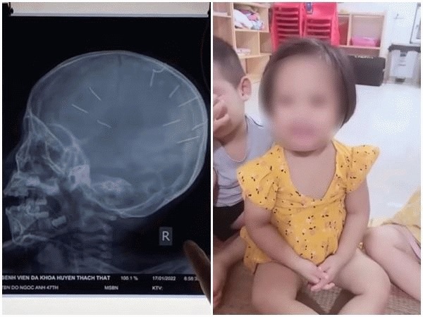 男子虐死女童 在她头颅插9根钉子