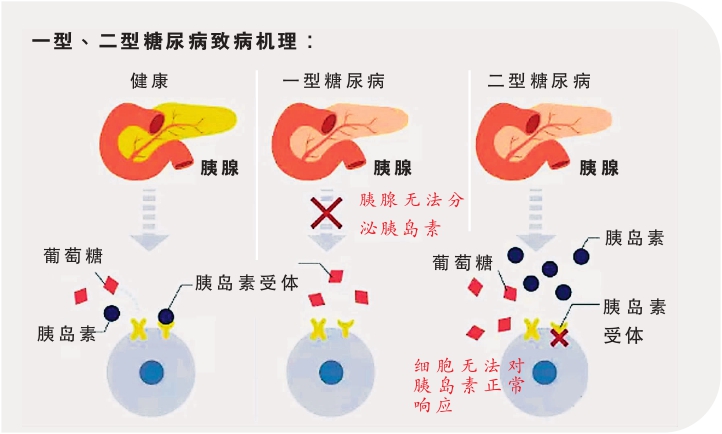 糖尿病 圖表