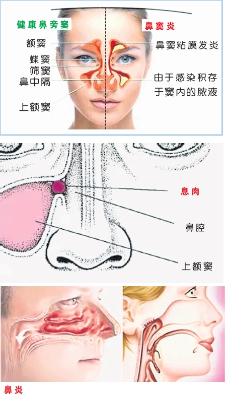 鼻窦炎