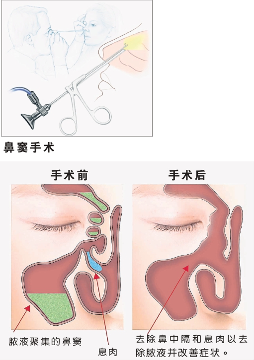 鼻窦手术