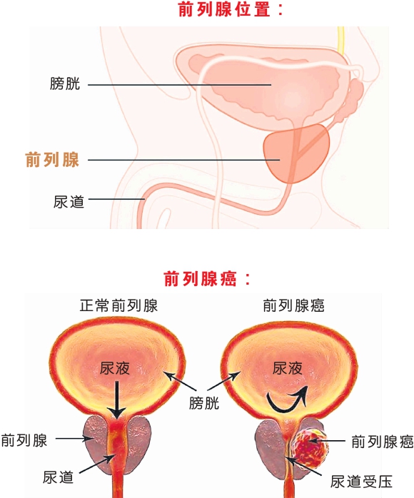 前列腺癌