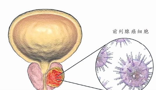前列腺癌 图表