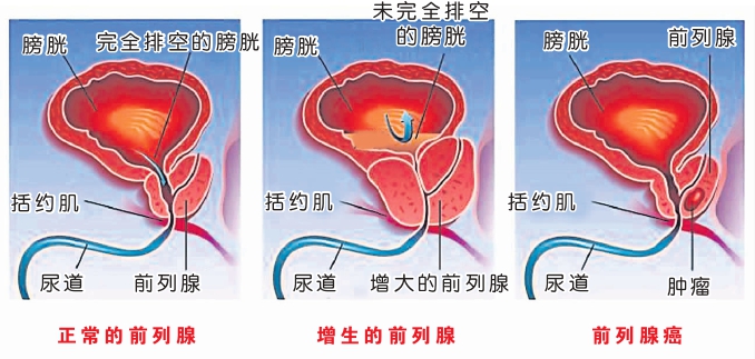 前列腺癌 图表