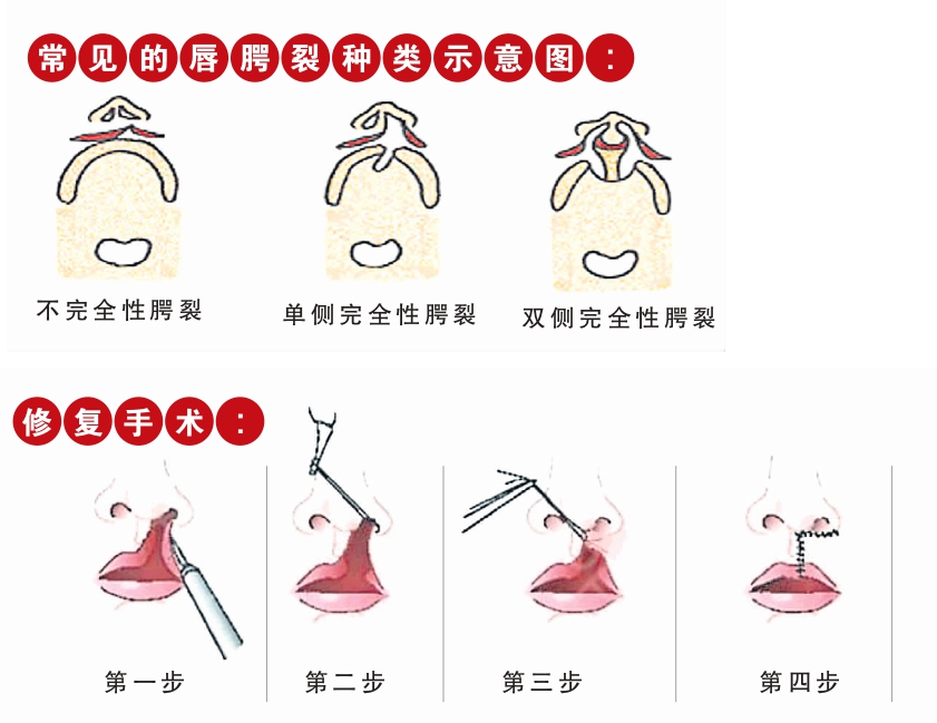 唇腭裂种类