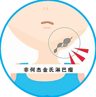 非何杰金氏淋巴瘤