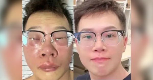 長期挖鼻子感染 男子“臉暴風膨脹”變豬頭　