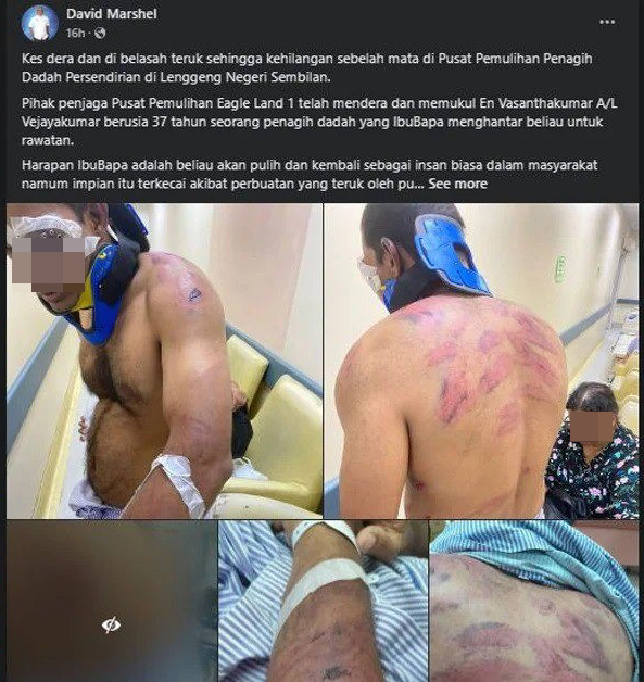 戒毒者遍体鳞伤左眼打瞎 前市议员控诉戒毒所施暴