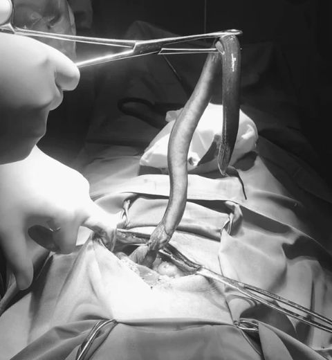 男子腹部痛爆送急诊 竟遭30公分鳗鱼咬穿肠