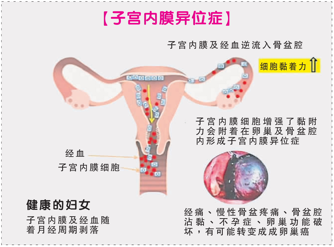 子宮內膜異位