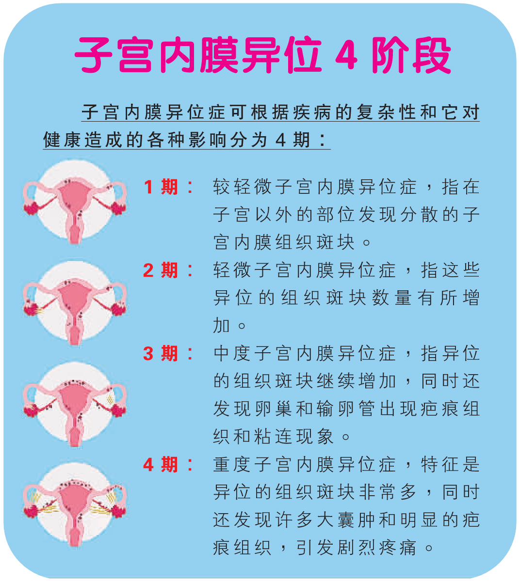 子宮內膜異位4階段
