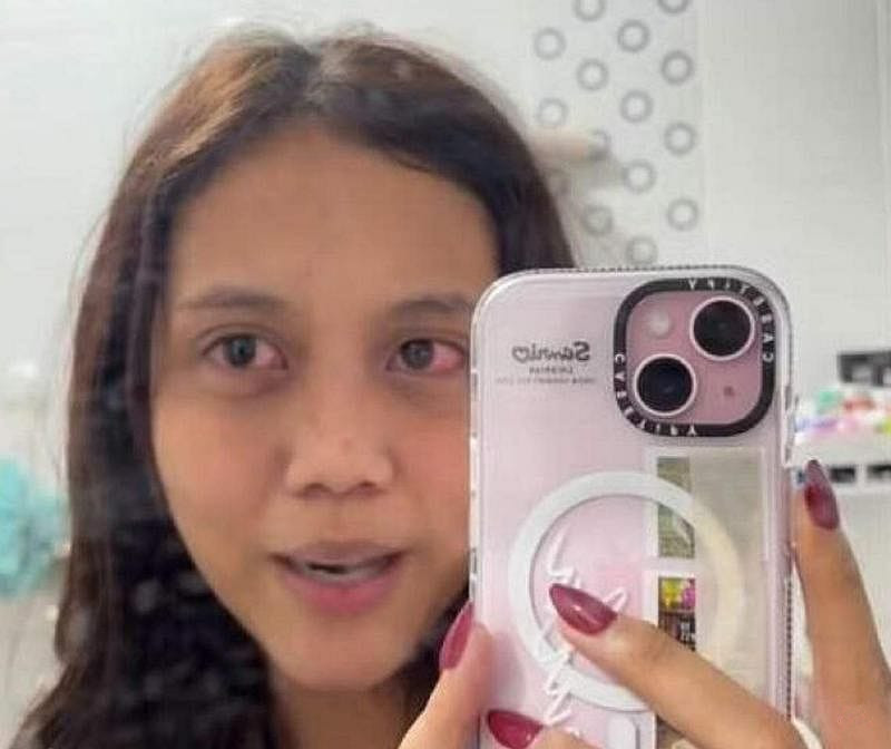 戴网购隐形眼镜引感染 女网红痛得想挖眼