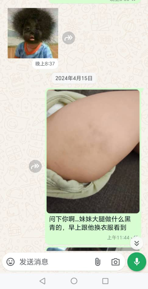 疑疏忽致女童脑死案