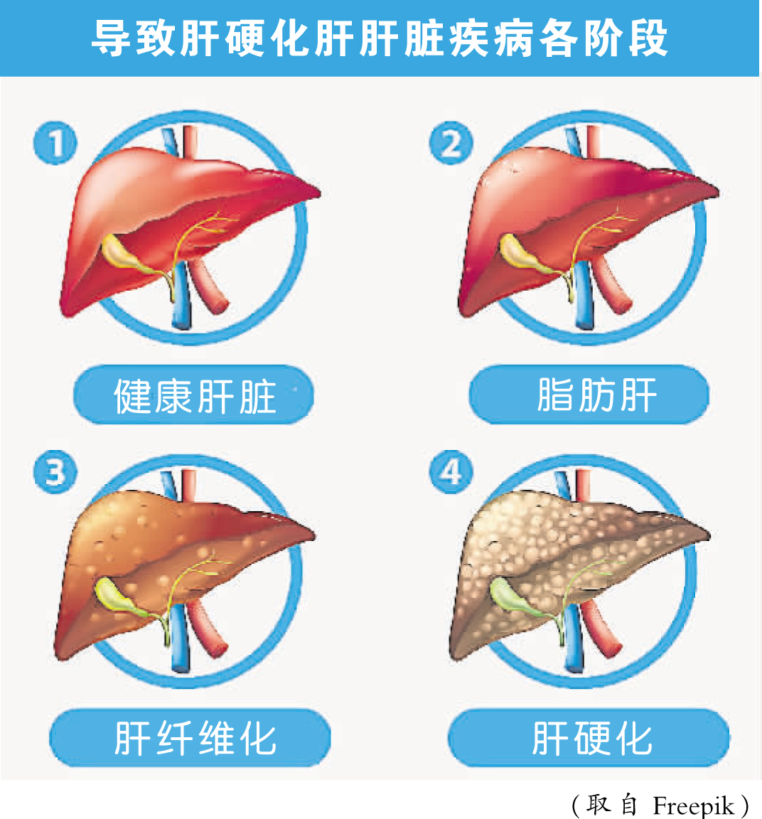 导致肝硬化肝肝脏疾病各阶段