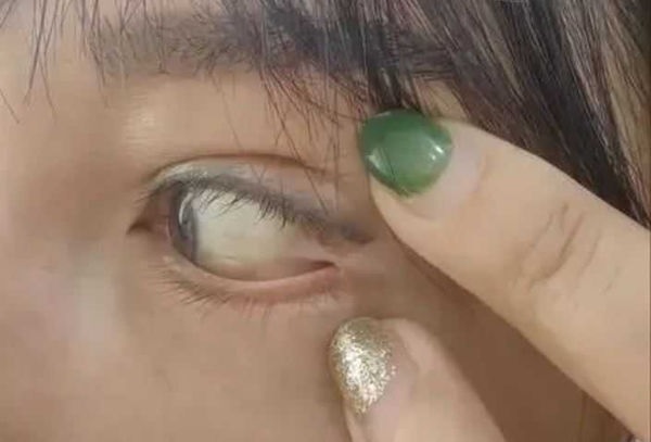 砸近2万割双眼皮 医生竟把眼皮缝在眼球上