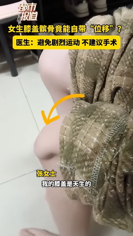 【视频】江苏少女天生髌骨脱位 双膝盖“可随意移动”