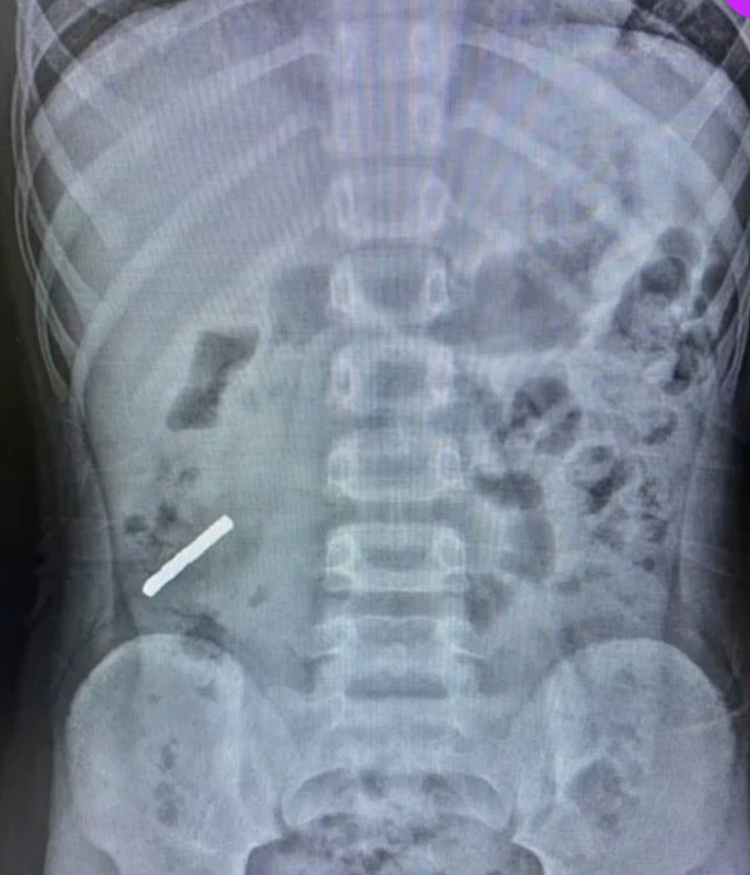 4岁童腹痛求诊 X光揭吞磁力玩具