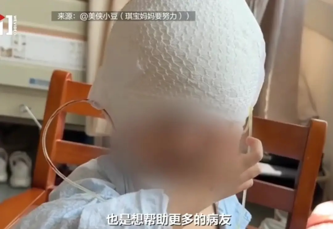 3歲男童罹巨痣遭嘲“米奇老鼠”5個月手術後重拾自信