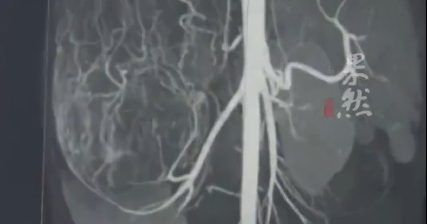 少女试裤被提醒“肚子太大”意外查出巨大肿瘤