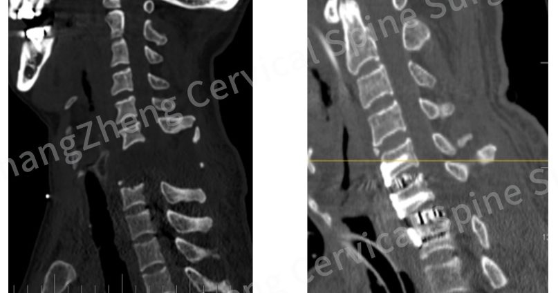 中国医院奇迹救回“颈椎断开”患者 医生:情况恶劣如断头