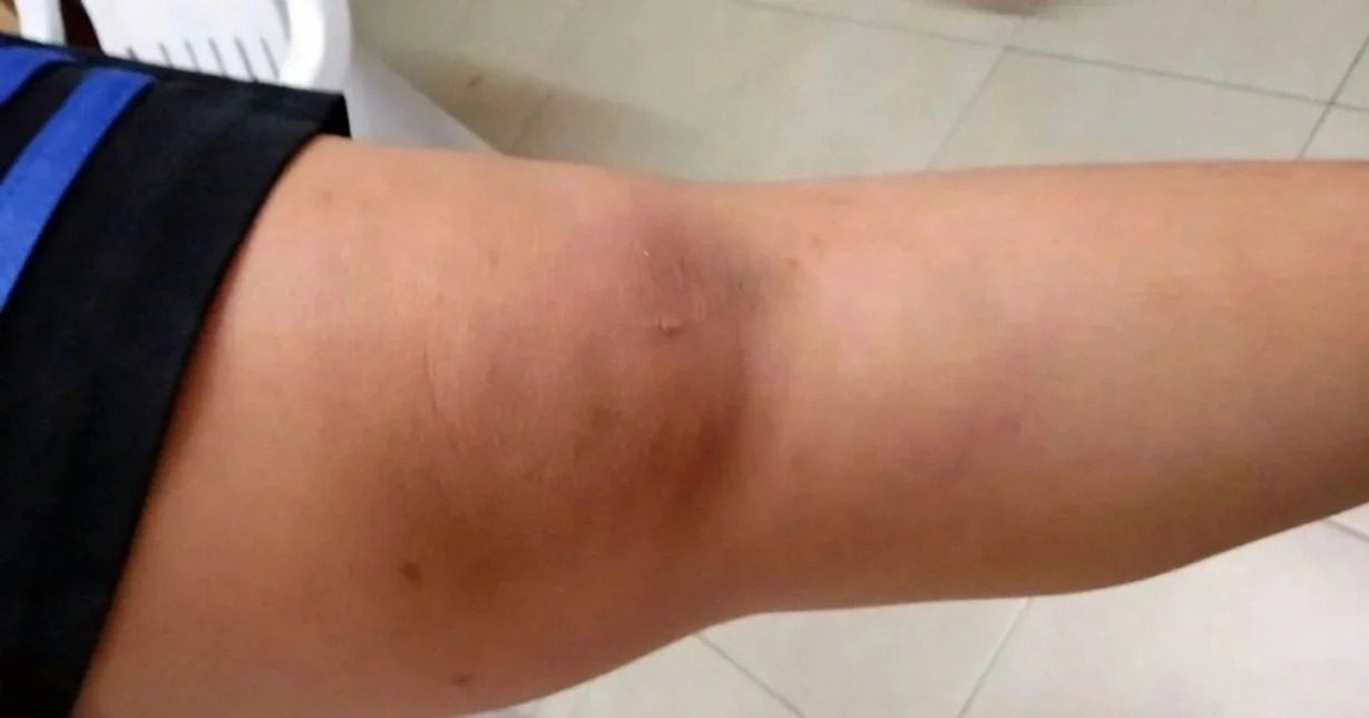 四年级生遭学生群殴事件 校方:嬉闹冲突非霸凌